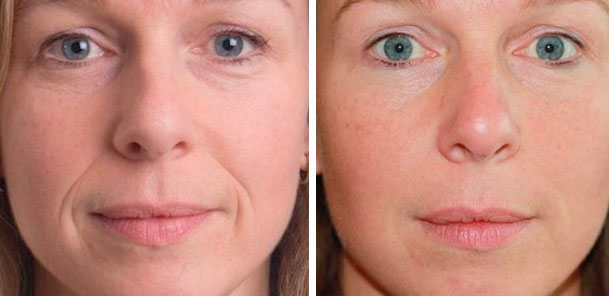 Миндальный пилинг для лица – фото до и после